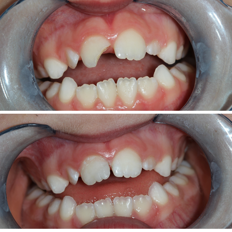 composite white fillings